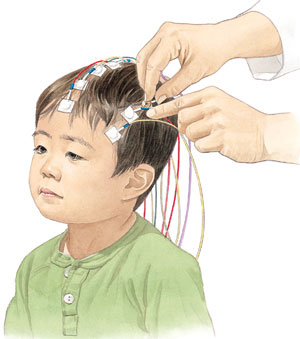  Epilepsi tanısında genel fizik ve nörolojik muayene yapıldıktan sonra başvurulacak ilk laboratuar inceleme aracı; elektroensefalografi (EEG) dir. Bu tetkik, saçlı deriye elektrotlar yapıştırılarak beyin dalgalarının kaydedildiği bir yöntemdir.  

   

